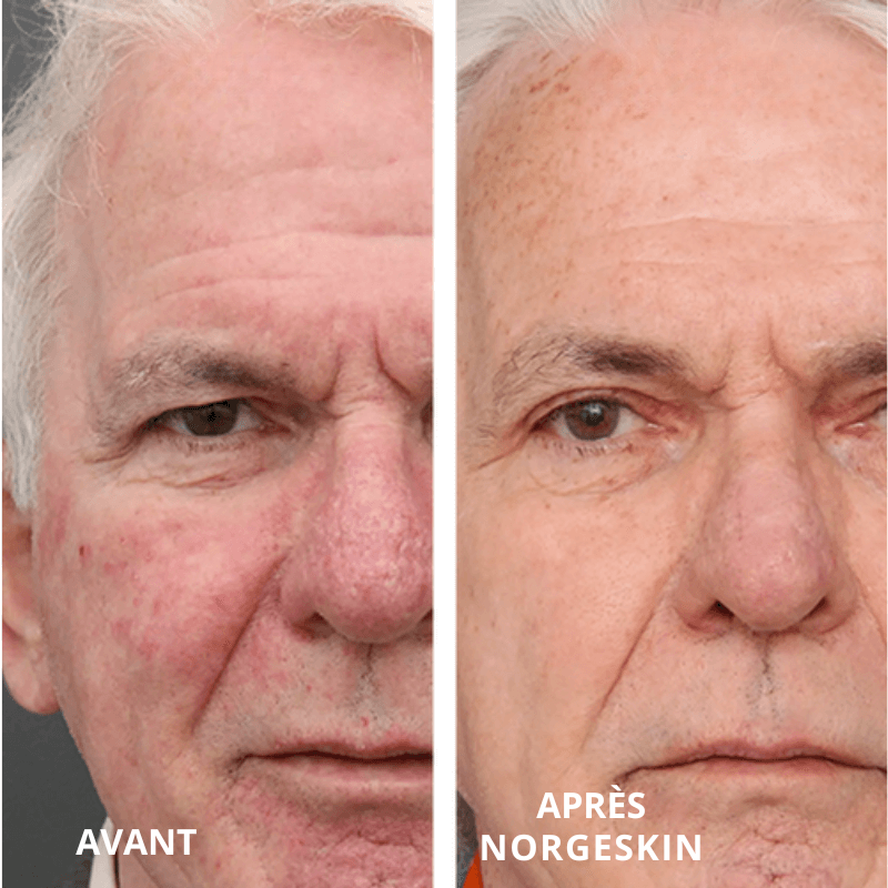 NORGESKIN® - Baume Anti-Âge Hydratant